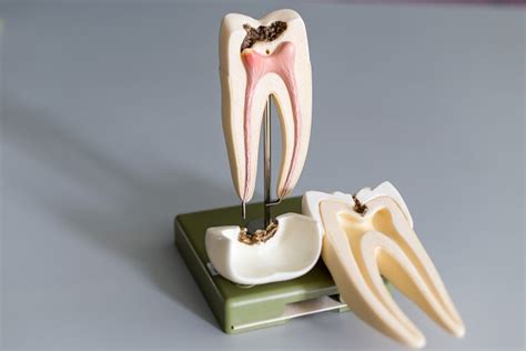 What are the Most Common Endodontic Procedures?