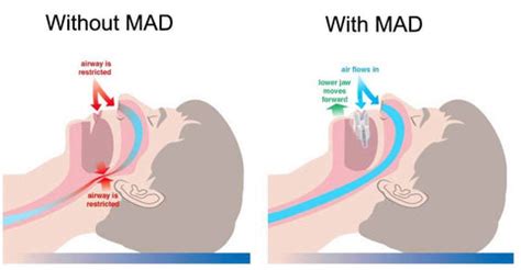 Mandibular Advancement Device – Perth CPAP