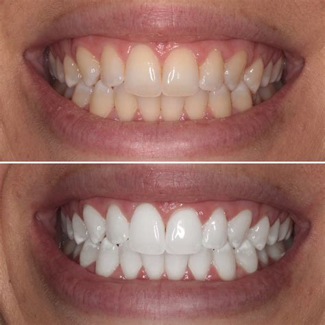 Affordable Teeth Whitening | Celina/Prosper Dentist