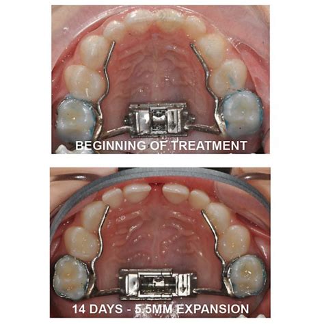 TruEase Rapid Palatal Expanders - Ortho Technology