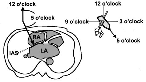 The Guidewire Technique for Transseptal Puncture