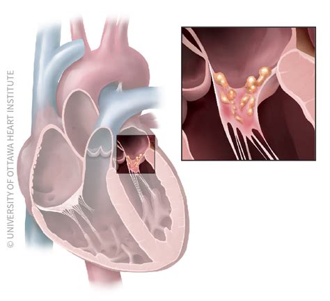 Endocarditis | University of Ottawa Heart Institute