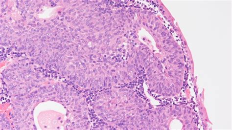 episodio Non si muove scrittura inverted papilloma histology ...