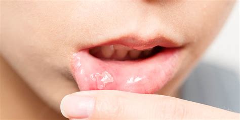 Horrible Mouth Ulcers may be caused by STDs