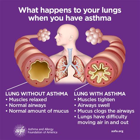 Scientists unveil potential asthma treatment, raising hope for patients - Healthwise