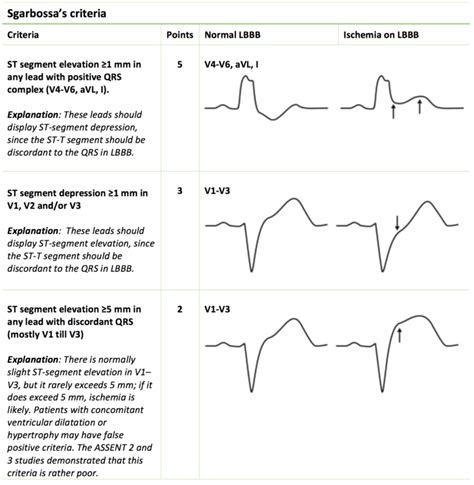 Table 1. Sgarbossa's criteria. – ECG learning