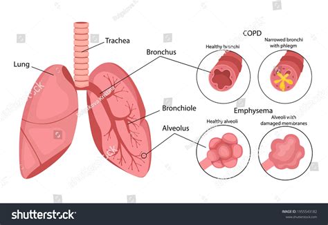 Copd Chronic Obstructive Pulmonary Disease Emphysema Stock Vector (Royalty Free) 1955543182 ...