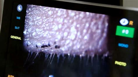 Clinical Impact of Demodex Blepharitis - Eyetube