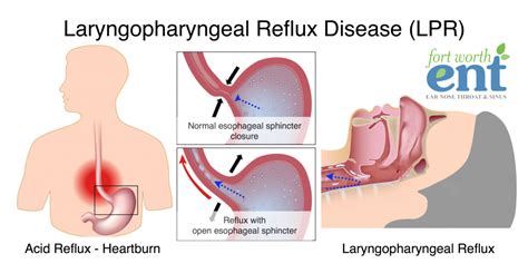 Laryngopharyngeal Reflux Disease (LPR) | Fort Worth ENT & Sinus