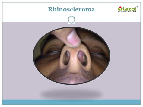 PPT - Rhinoscleroma: Causes, Symptoms, Daignosis, Prevention and Treatment PowerPoint ...