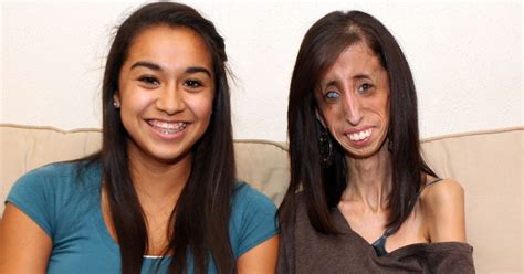 World's Thinnest Woman Lizzie Velasquez Who Has A Medical Condition ...