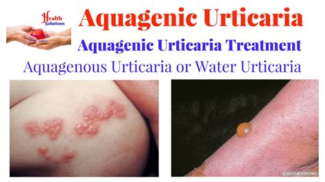 Aquagenic Urticaria - Aquagenous Urticaria or Water Urticaria - Aquagenic Urticaria Treatment ...