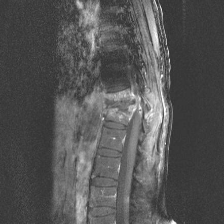 Tuberculosis MRI - wikidoc