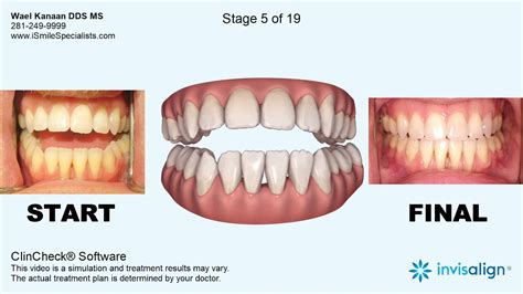 Invisalign open bite correction with Surgery - YouTube