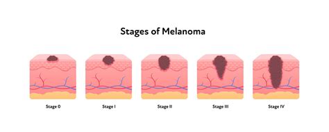 Charlotte Skin Cancer Treatment & Radiation Therapy | SERO