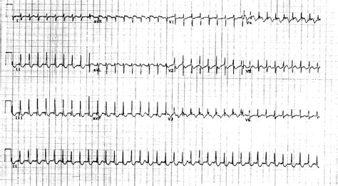 Junctional ectopic tachycardia evolving into complete heart block | Heart