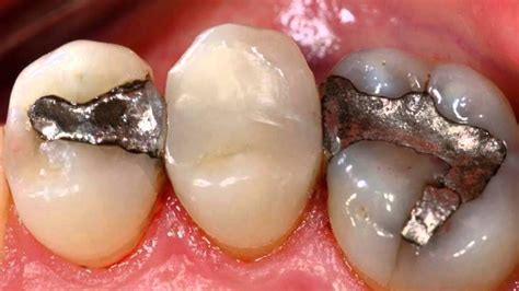 Composite vs Amalgam - YouTube