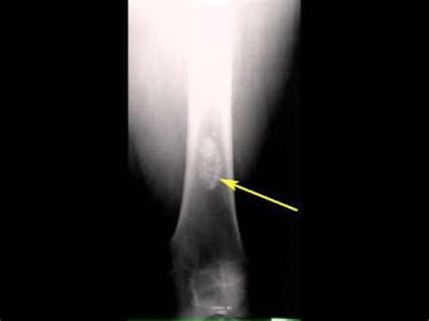 Enchondroma Distal Femur - YouTube