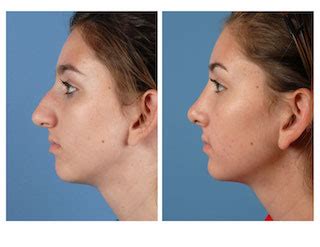 Rhinoplasty: What to expect before and after a ‘nose job’ | Plastic Surgery | UT Southwestern ...