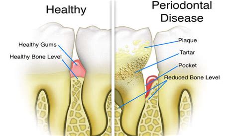 Periodontal Gum Disease, Gingivitis Causes and Treatment