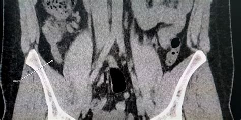 CT Scans in the Diagnosis of Appendicitis | Journal of Ethics | American Medical Association