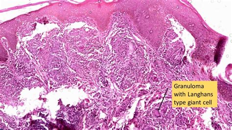 LEPROSY- Tuberculoid & Lepromatous - Pathology Made Simple