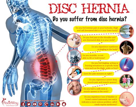 Do you suffer from #DiscHernia? Nerve Health, Human Spine, Weekly ...