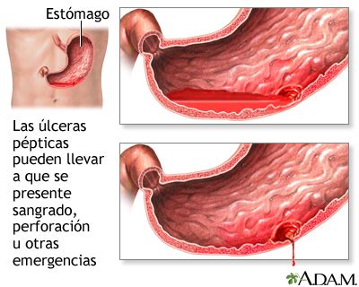 Hemorragia digestiva: síntomas, causas y tratamiento – Todo en la red