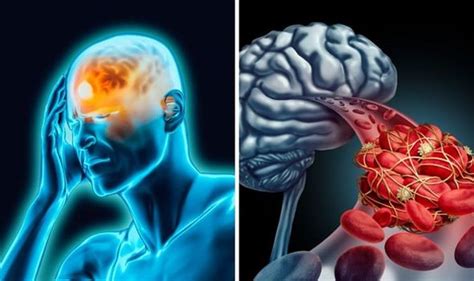 Cerebral Venous Sinus Thrombosis symptoms: What are the warning signs of the blood clot ...