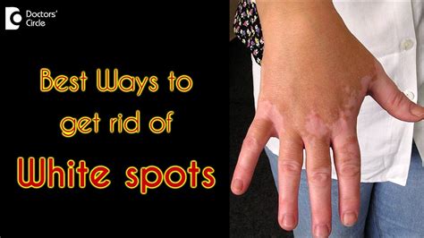 How to treat white spots on the skin? - Dr. Rasya Dixit - YouTube