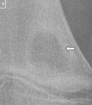 Brodie’s abscess | Radiology Key