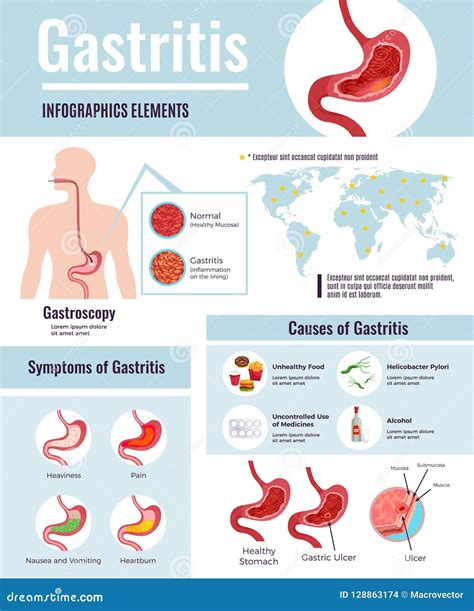 Gastritis Infographic Poster Stock Vector - Illustration of alcohol ...