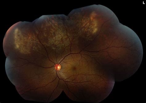 Serpiginous Choroiditis – September 2020 | Illinois Retina Associates™: Top Retina Specialists ...