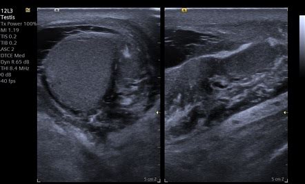 Epididymo-orchitis | Image | Radiopaedia.org