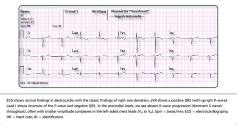 Left-Sided ECG of a 50-Year-Old Man With Dextrocardia Situs Inversus ...