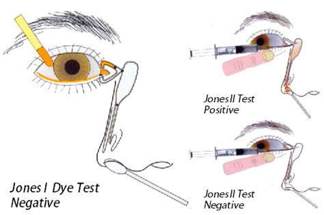 Uses of Fluorescein strips | Epomedicine