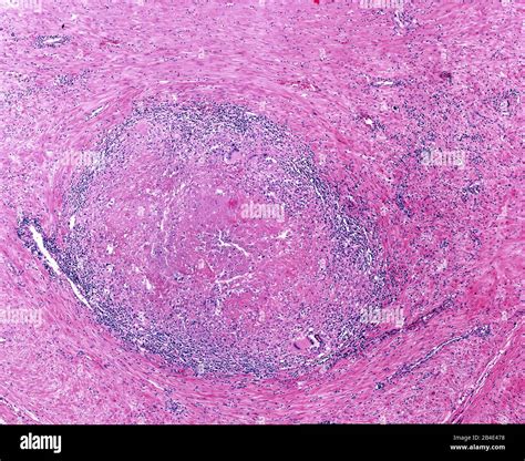 Tuberculosis granuloma with a central necrosis (caseous necrosis ...