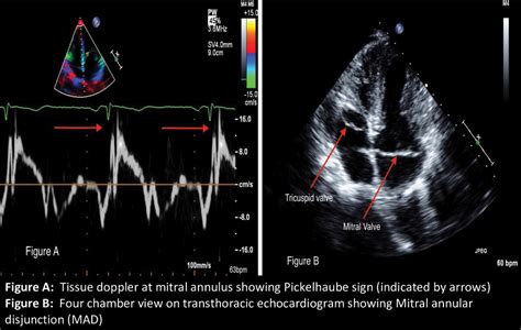 RARE ECHOCARDIOGRAPHIC FINDING OF MITRAL ANNULAR DISJUNCTION (MAD) AND PICKELHAUBE SIGN ...