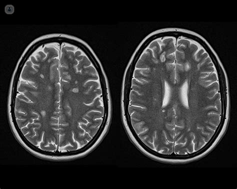 Ms Mri Brain Scan Results