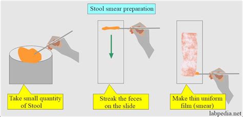 Stool Examination:- Part 1 - Normal Stool Examination Findings ...