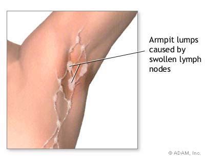 The New York Times > Health > Image > Swollen Lymph Nodes Under Arm