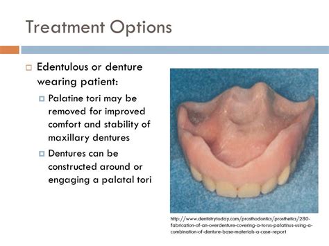 What Is Palatal Tori at Elsy Martin blog