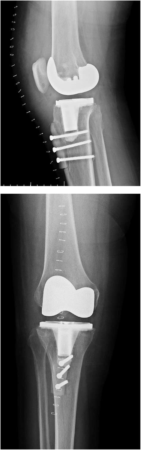 Treatment of late Patella Baja after an otherwise routine total knee arthroplasty - The Knee