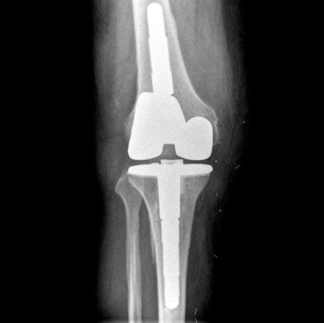 The Knee Clinic - Revision Knee Replacement - The Knee Clinic