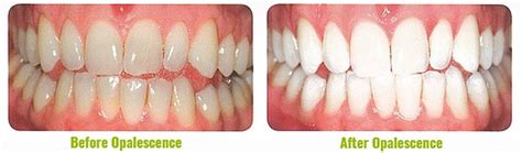 Teeth Whitening | Opalescence Treatment | Fall River, MA