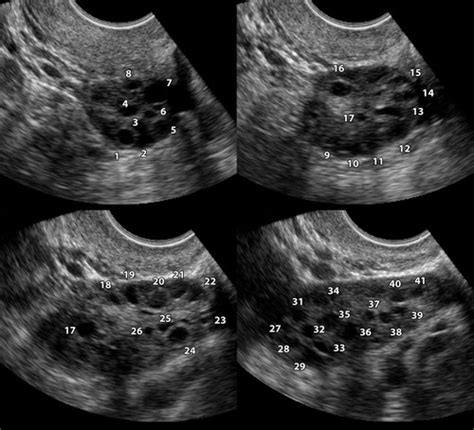 Polycystic Ovarian Syndrome: Role of Imaging in Diagnosis | RadioGraphics