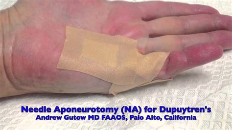 Office Treatment of Dupuytren's Contracture Needle Aponeurotomy and Xiaflex Injection - YouTube