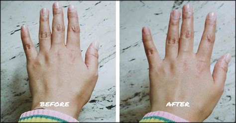 Bio Oil Before And After Pictures Scars - PictureMeta