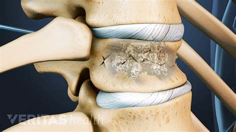 How a Vertebroplasty Procedure Eases Spinal Compression Fracture Pain