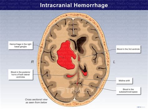 Intracranial Hemorrhage Grading